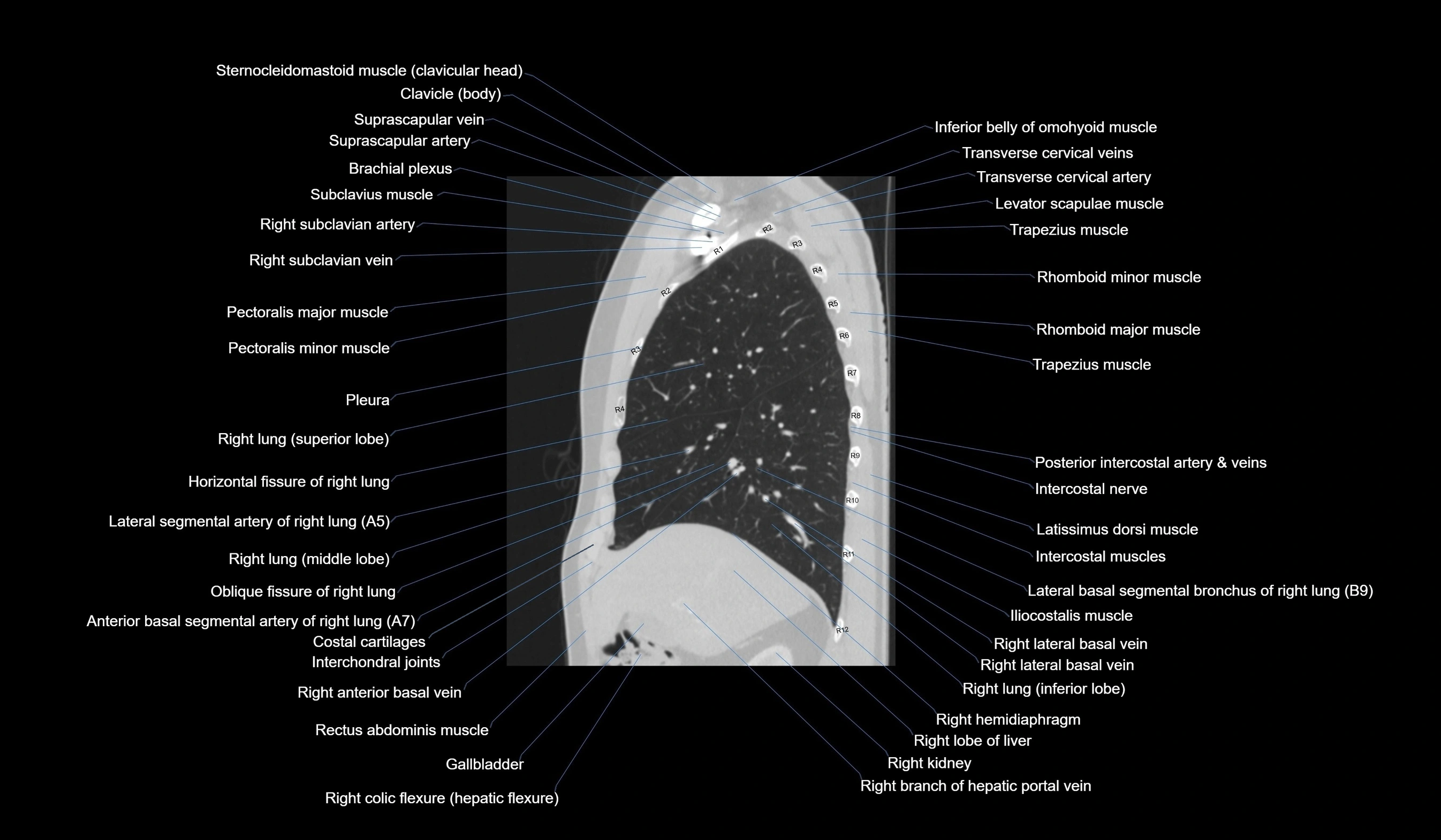 CT chest (thorax) lung window labelled sagittal cross sectional anatomy radiology image-00046.webp